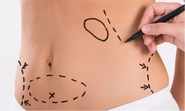Abdominoplastia en Lima