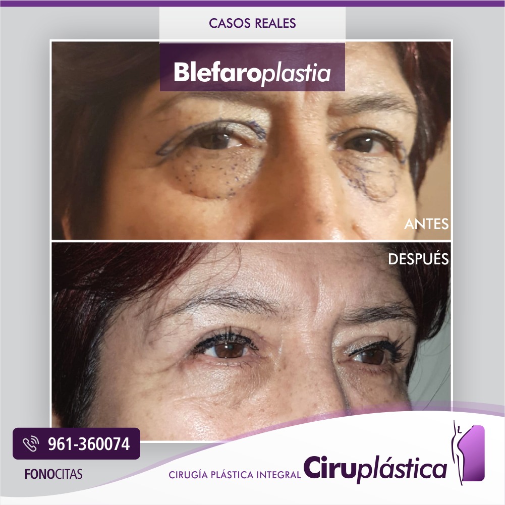Caso de blefaroplastia en Lima