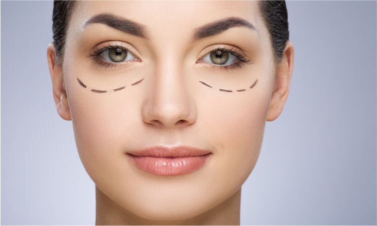 Blefaroplastia en Lima