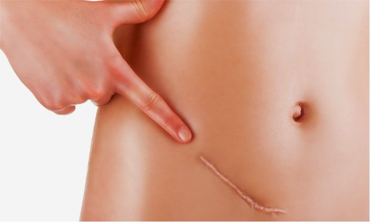 Tratamiento de Cicatrices en Lima