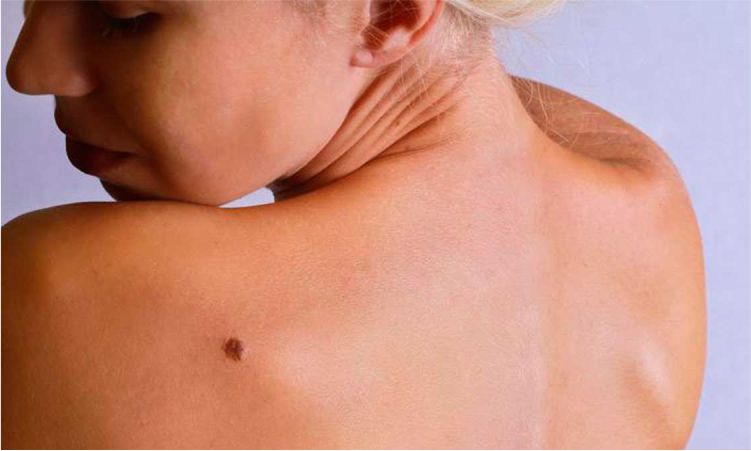 Extraccion de lunares en Lima