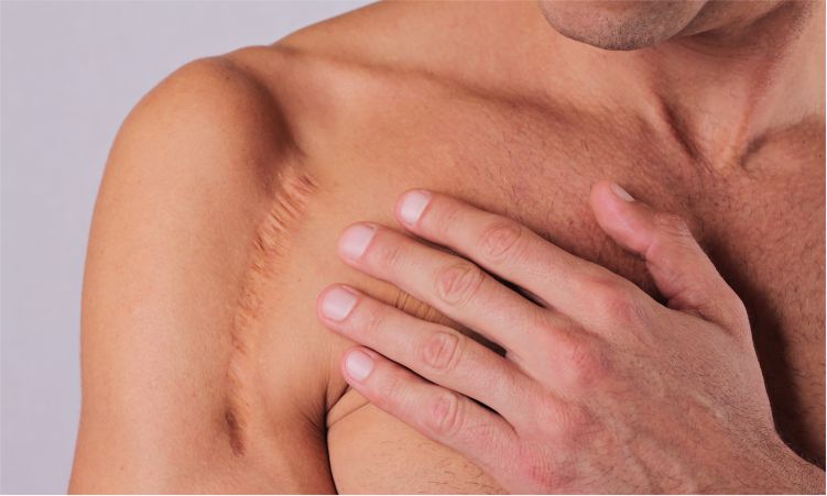 Tratamiento de heridas y ulceras complejas en Lima