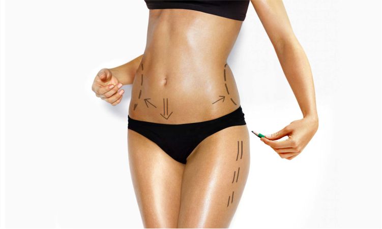 Lipoescultura en Lima