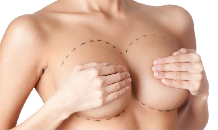 Mamoplastia de aumento en Lima